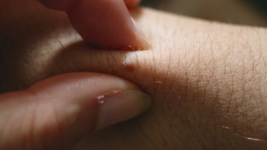 Skin Pickers